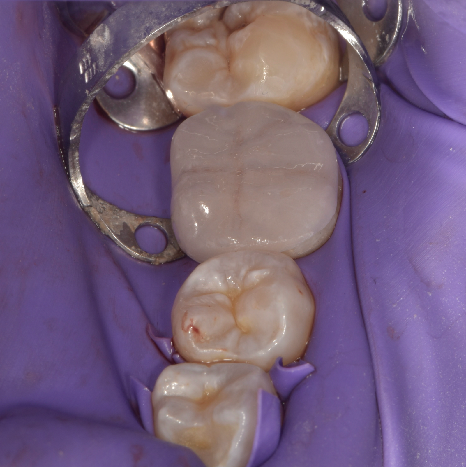 Crowns-Case 1-After