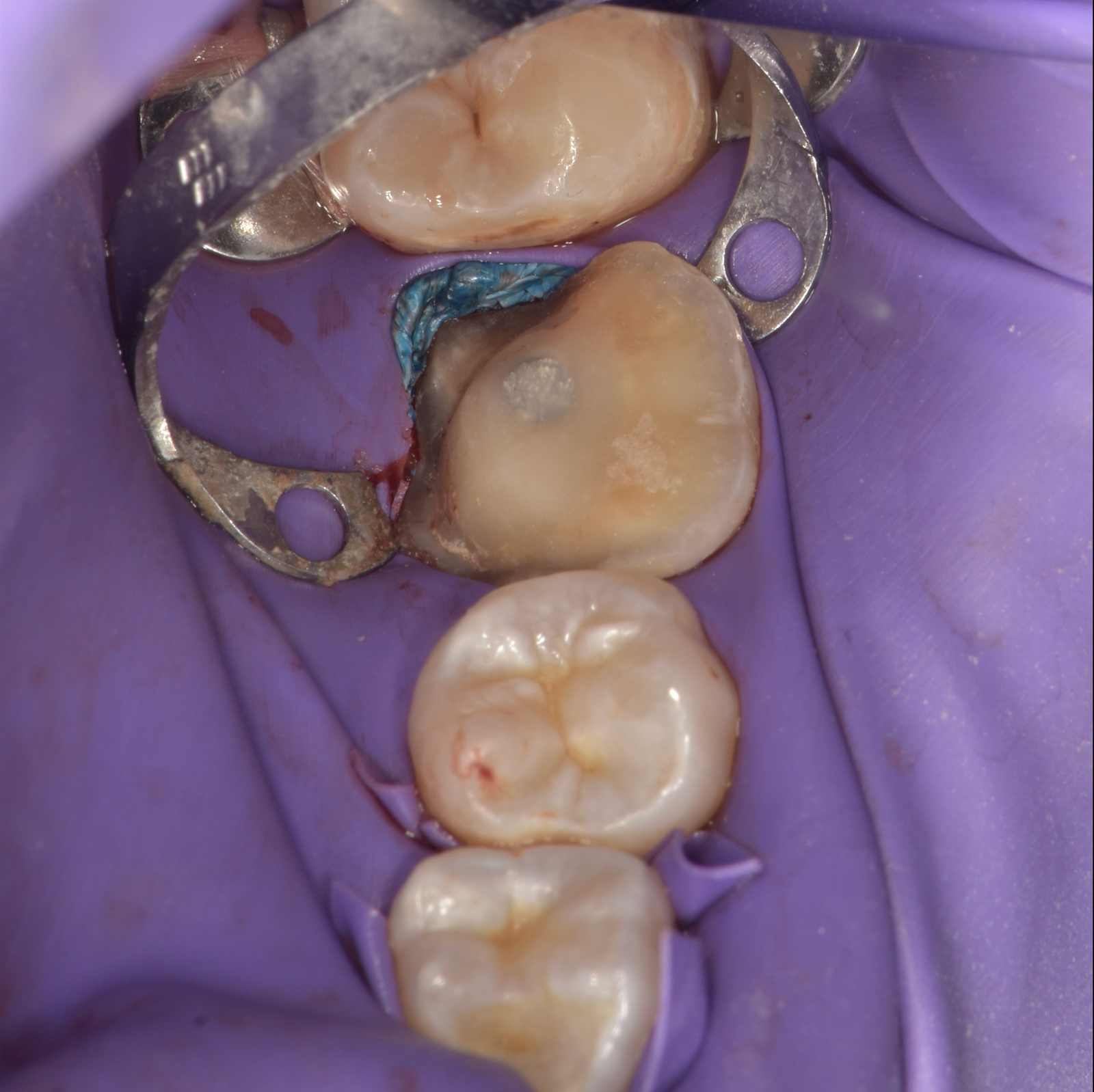 Crowns-Case 1-Before