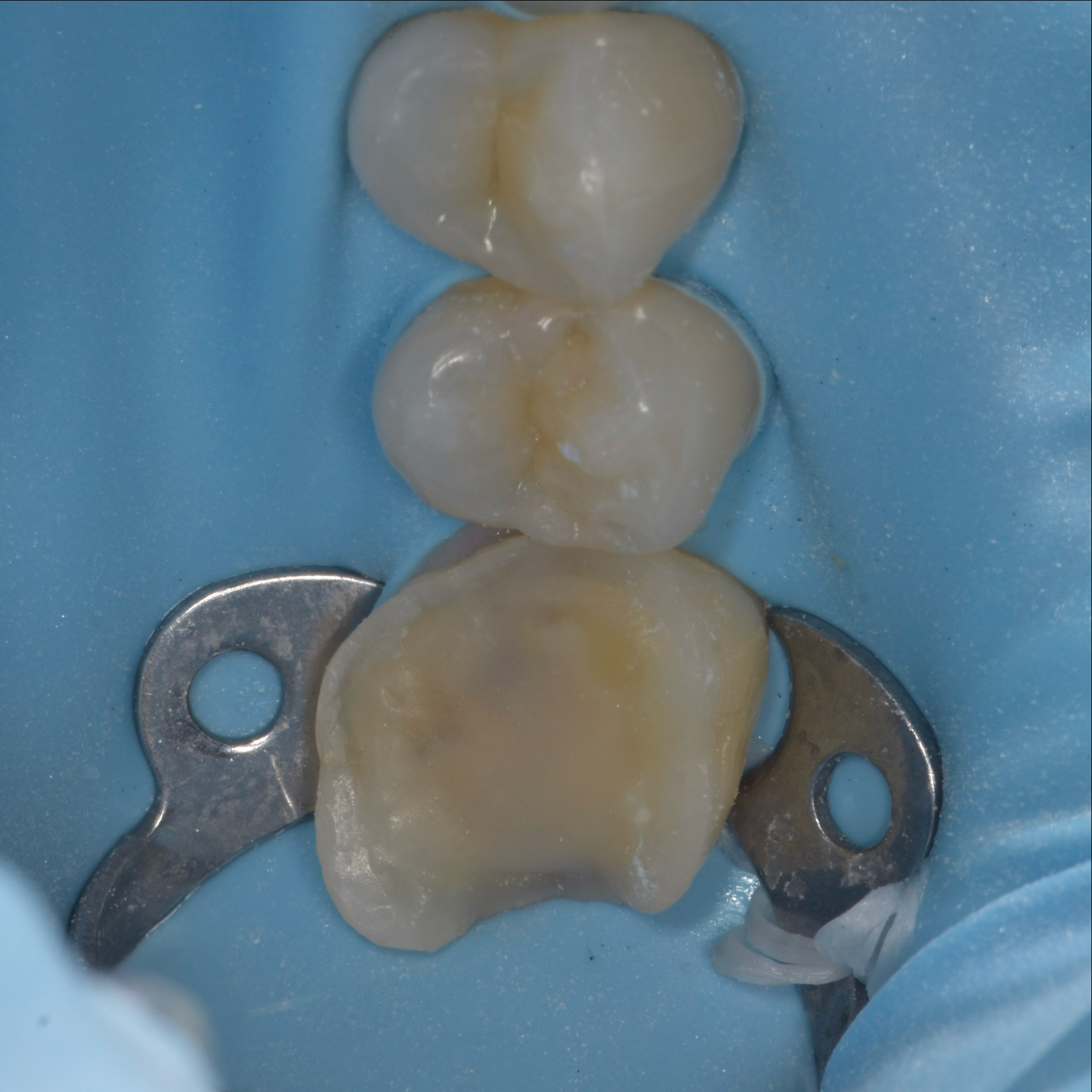 Crowns-Case 2-Before