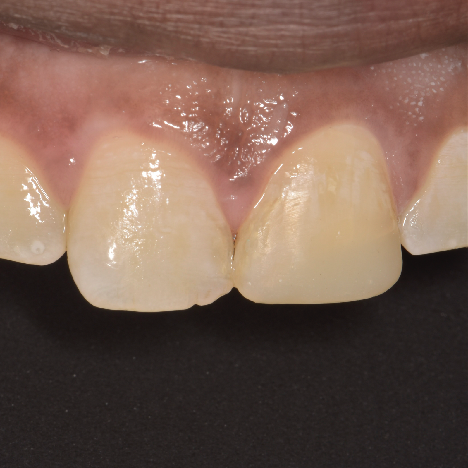 Esthetic Dentistry-Case 1-After