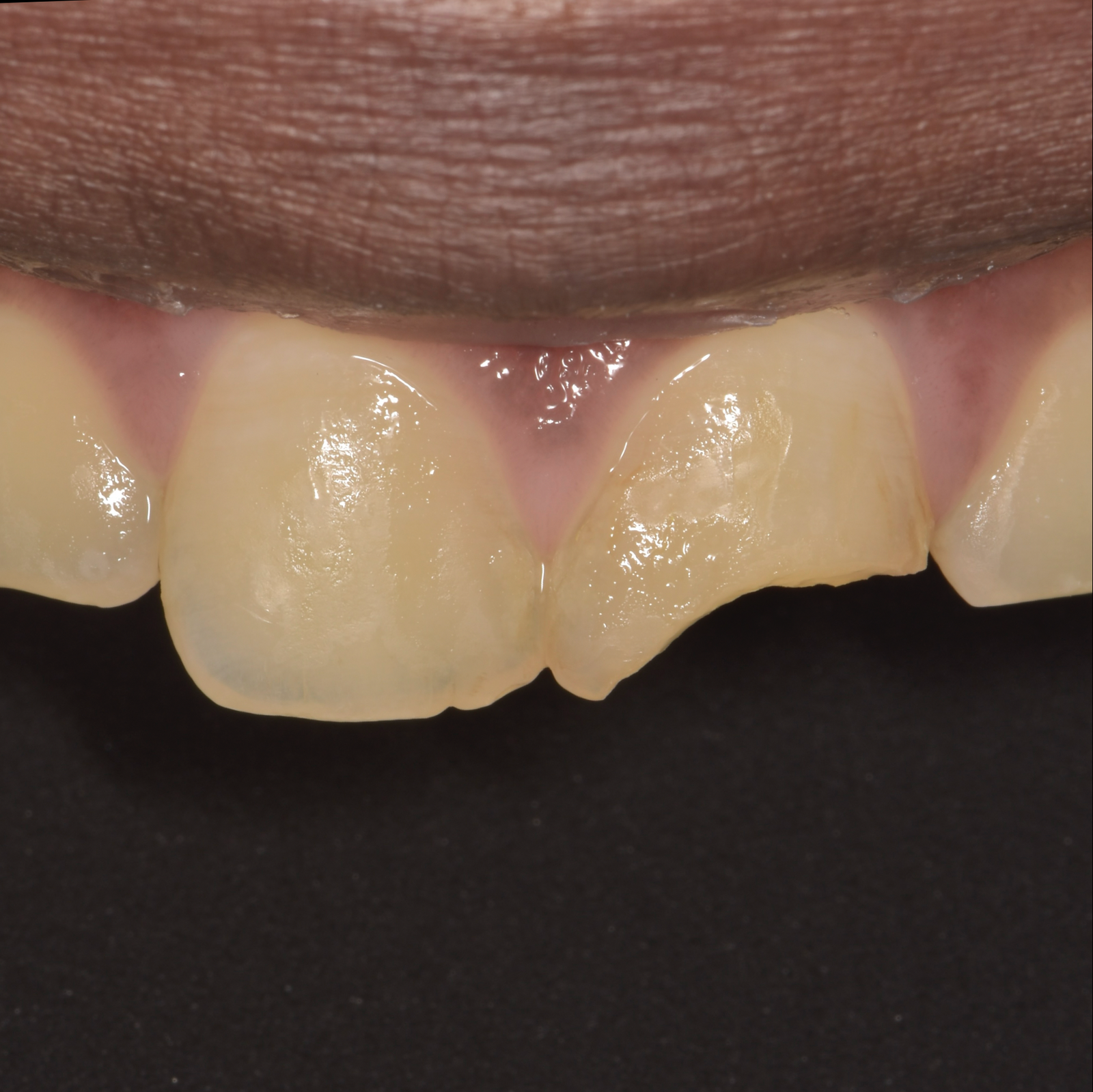 Esthetic Dentistry-Case 1-Before