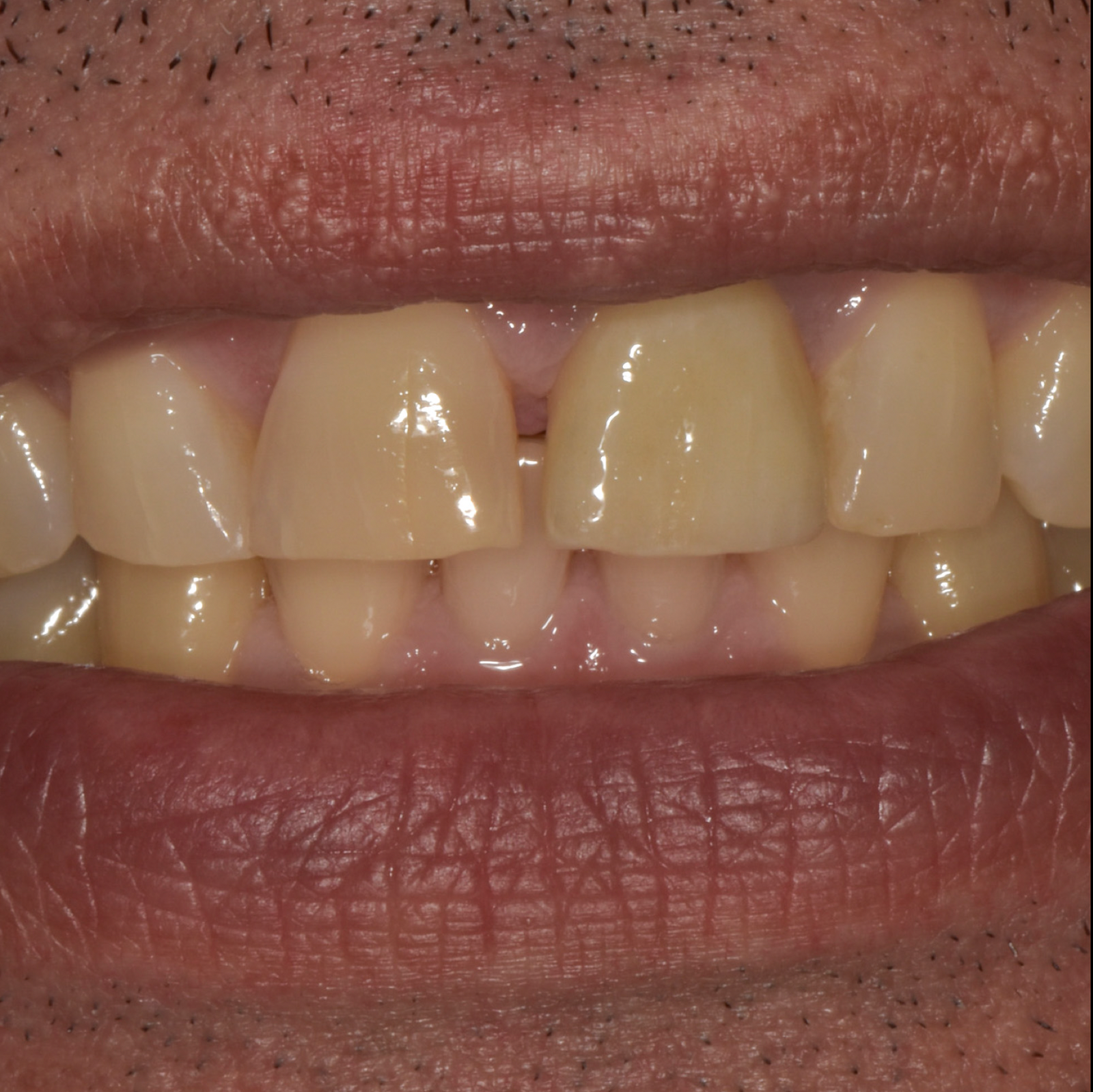 Esthetic Dentistry-Case 2-After