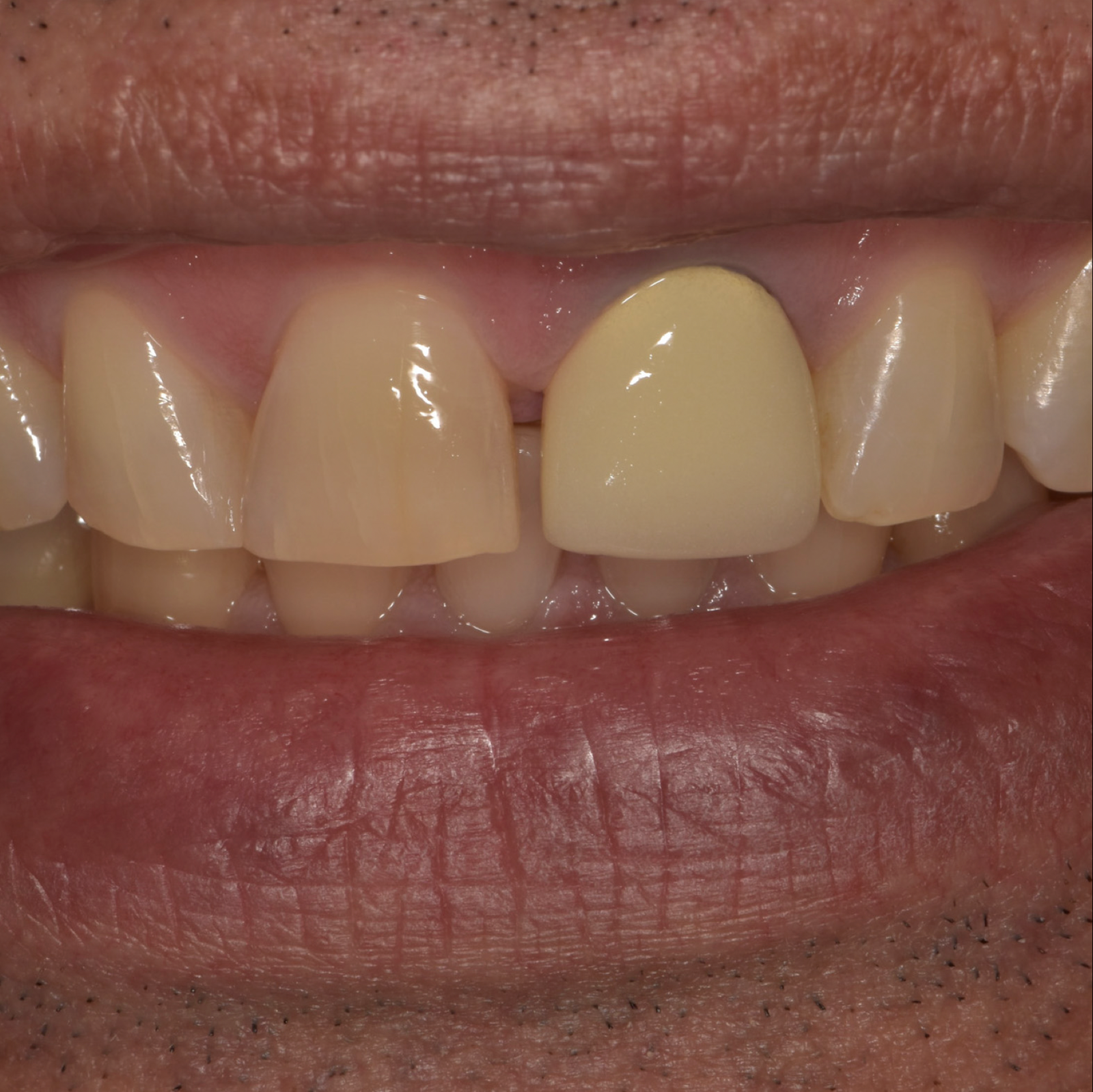 Esthetic Dentistry-Case 2-Before