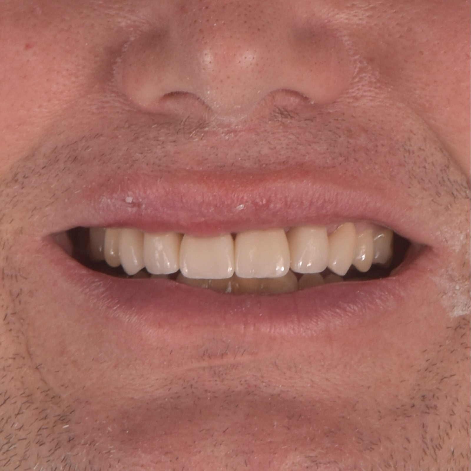 Esthetic Dentistry-Case 3-After