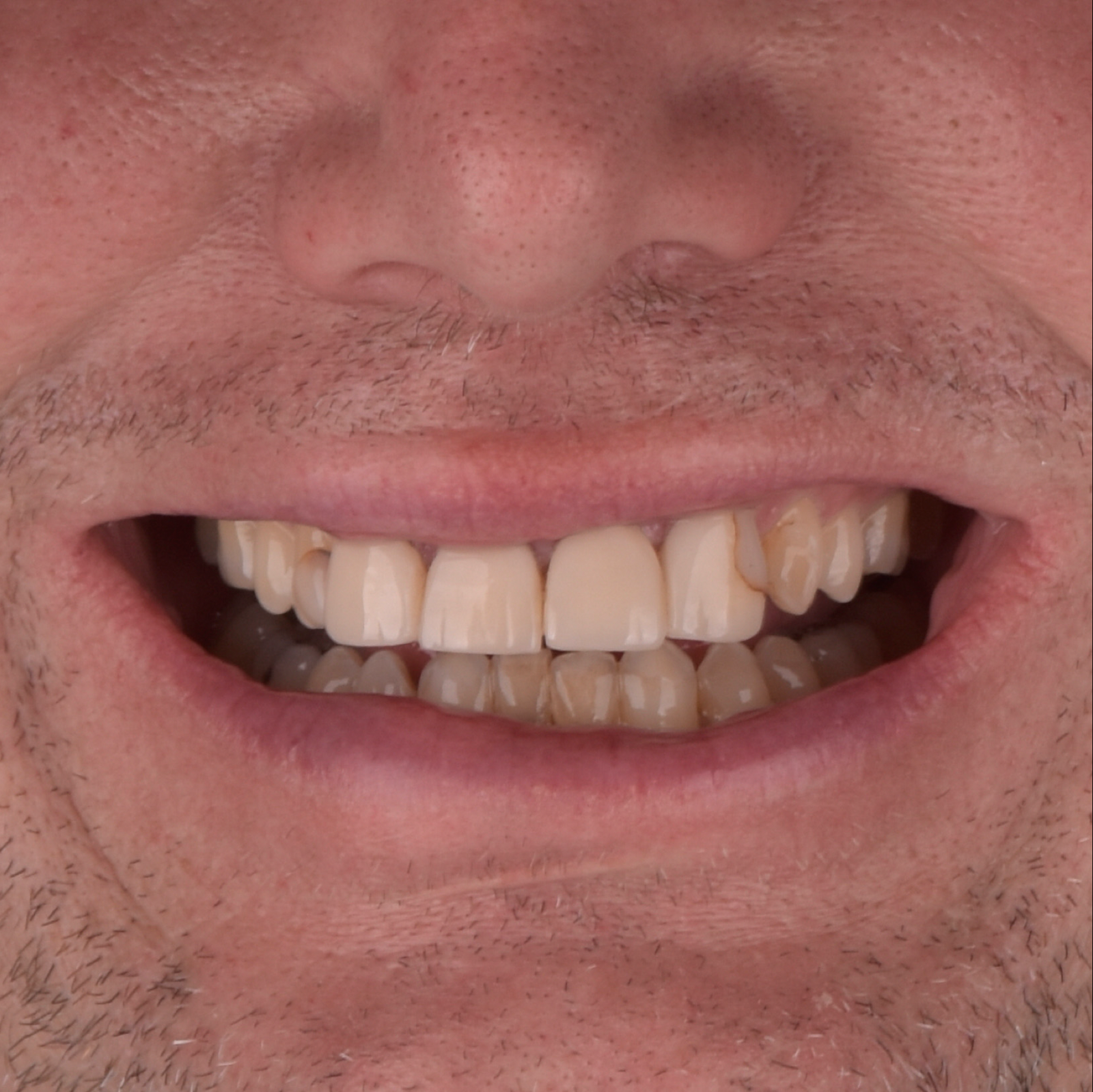 Esthetic Dentistry-Case 3-Before