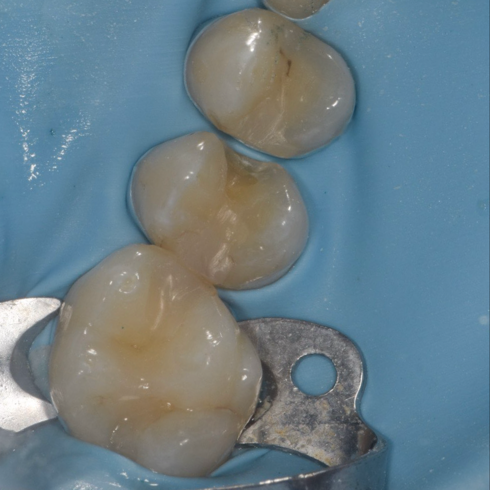 Fillings-Case 1-Before